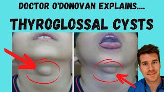 Explaining Thyroglossal Cysts  Origins Diagnosis and Management  With Dr ODonovan [upl. by Ahsikat936]