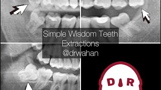 Erupted Wisdom Teeth Extractions Step by Step drwahan [upl. by Kaylil34]