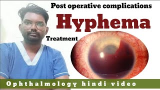 hyphema  post operative complications in eye  hyphema treatment  hindiophthalmology  optometry [upl. by Ettennad]