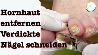 Verdickte Nägel fräsen und Hornhaut entfernen podologinandrea [upl. by Ocko708]