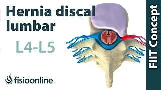 Hernia discal lumbar entre la L4 y L5 o cuarta y quinta vértebras lumbares [upl. by Rhoades]