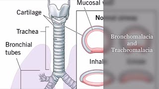 Bronchomalacia and Tracheomalacia [upl. by Melan]