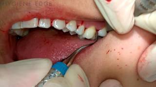 Gracey Instrumentation During Periodontal Therapy [upl. by Varhol]