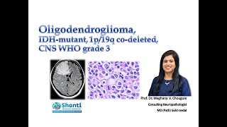 Oligodendroglioma IDH1mutant 1p19q codeleted [upl. by Enair]