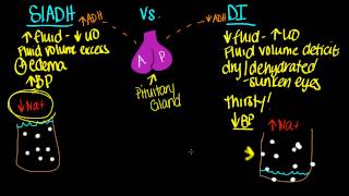 SIADH vs DI [upl. by Aveneg]