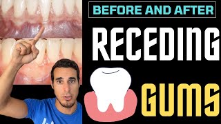 RECEDING GUMS  Before and after [upl. by Adnical699]