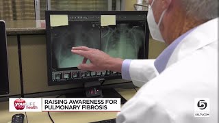 New drug slows scaring of the lungs due to pulmonary fibrosis [upl. by Fraser]