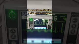 Normal Sinus Rhythm with Atrial Ectopic beats ecg cardiology [upl. by Irrak613]