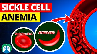 Sickle Cell Anemia  Quick Explainer Video [upl. by Aerona]