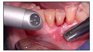 Periodontitis Treatment [upl. by Yelime840]