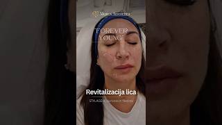 Lifting lica hijaluronskim filerima Forever young Medica Aesthetica skincare filler facelift [upl. by Akenn487]