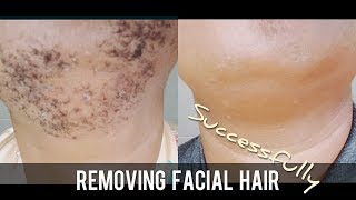 Chin hair  BEST FACIAL HAIR REMOVAL avoid razor bumps when shaving womens beards [upl. by Kerry]