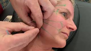 Bells Palsy Nerve Acupuncture Stimulation [upl. by Basil]