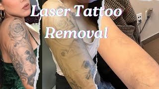 Laser Tattoo Removal Experience [upl. by Aneema88]