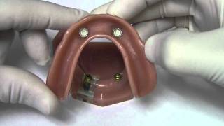 Implant Overdenture  Model Demonstration [upl. by Phillipp]