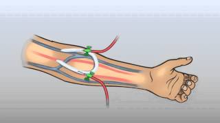 ARTERIOVENOUS GRAFT [upl. by Aitahs916]