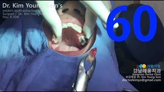 premolar extraction with forceps for orthodontic treatment [upl. by Sebbie311]