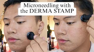 Acne Scar Treatment using Derma Stamp from Banish [upl. by Onitnerolf425]