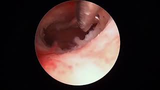 Hysteroscopic lysis of adhesions for Asherman Syndrome [upl. by Carver]