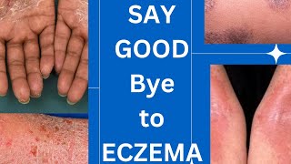 Management guidelines of eczema skin specialist advice How to treat eczemaskinhealthvitality5959 [upl. by Biles513]