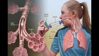 Breathe Easy  Understanding Asthma 6 Minutes [upl. by Ahsitniuq]