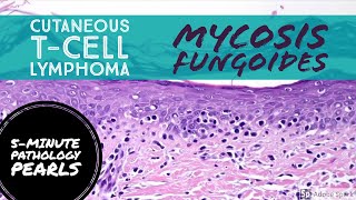 Mycosis Fungoides Cutaneous TCell Lymphoma 5Minute Pathology Pearls [upl. by Eimmot652]