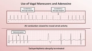 Intro to EKG Interpretation  How to Identify Any Tachyarrhythmia with 6 Easy Questions [upl. by Bianka]