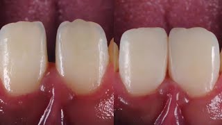 Diastema Closure using composite diastema [upl. by Lerraj355]