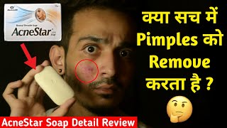 क्या AcneStar Soap सच में Acne Pimples को Remove करता है  Detail Review Uses Benefit Side Effect [upl. by Aldo437]