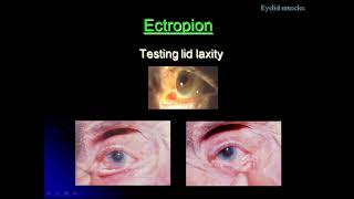 A Class On Ectropion By Dr VivekanandDept Of Ophthalmology [upl. by Cardwell]