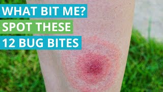 What Bit Me Spot These 12 Bug Bites [upl. by Loux495]