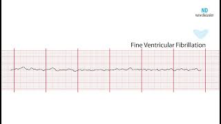 Fine Ventricular Fibrillation ECG Review Learn the Heart [upl. by Aicelaf671]