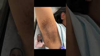 Laser Hair Removal Burn in Dark Skin woman [upl. by Nwahsed]