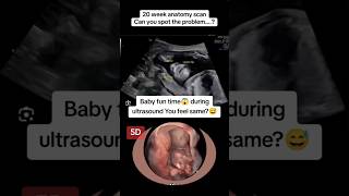 20 weeks anotomy scan fun time on ultrasound😅🫢viralvideo trending viralshorts [upl. by Hpeseoj807]