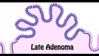 Animated Histology Colon Cancer Progression [upl. by Epilef]