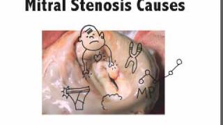 Mitral Stenosis Causes Mnemonic [upl. by Ymmit]