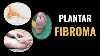 Plantar Fibroma [upl. by Tomkins]