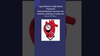 ATHEROSCLEROSIS nclex rn nursing nursingfoundation atherosclerosis healthawreness medical [upl. by Eilis]