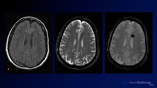 Neuroradiology Board Review  Brain Tumors  Case 12 [upl. by Hayton]