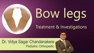 Hi9  Bow legs Treatment amp Investigations   Bow legs  Knock Knees  DrVidya Sagar Chandanakere [upl. by Dehnel]