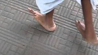 Talipes Calcaneus Deformity Walking Video [upl. by Leafar515]