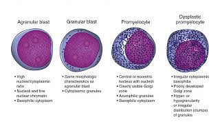 Myelodysplastic Syndrome [upl. by Alekahs]