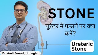 🥶 Ureter में पथरी फस गई  Symptoms and Treatment  Kidney Stone in Ureter II Dr Amit Bansal [upl. by Rosenbaum]