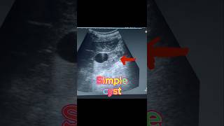 Simple Renal Cyst  Cortical Cyst  Kidney Cyst on Ultrasound [upl. by Placido]