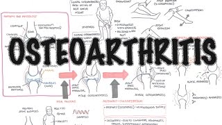 Osteoarthritis Overview causes pathophysiology investigations treatment [upl. by Ogdan]