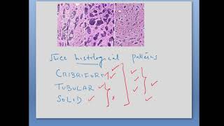 Adenoid Cystic Carcinoma Final 2024 [upl. by Mariko]