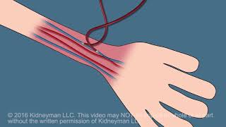 Dialysis Fistula animation [upl. by Aicelf]