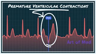 Premature Ventricular Contrcations Ventricular Bigeminy Trigeminy Quadrigeminy [upl. by Llerrut]