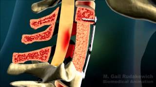 Riluzole as treatment for Spinal Cord Injury [upl. by Naenej]