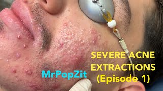 Severe acne extractions episode 1 Comedones and pore dirt removed Part 1 of 3 So many pops [upl. by Kerman]